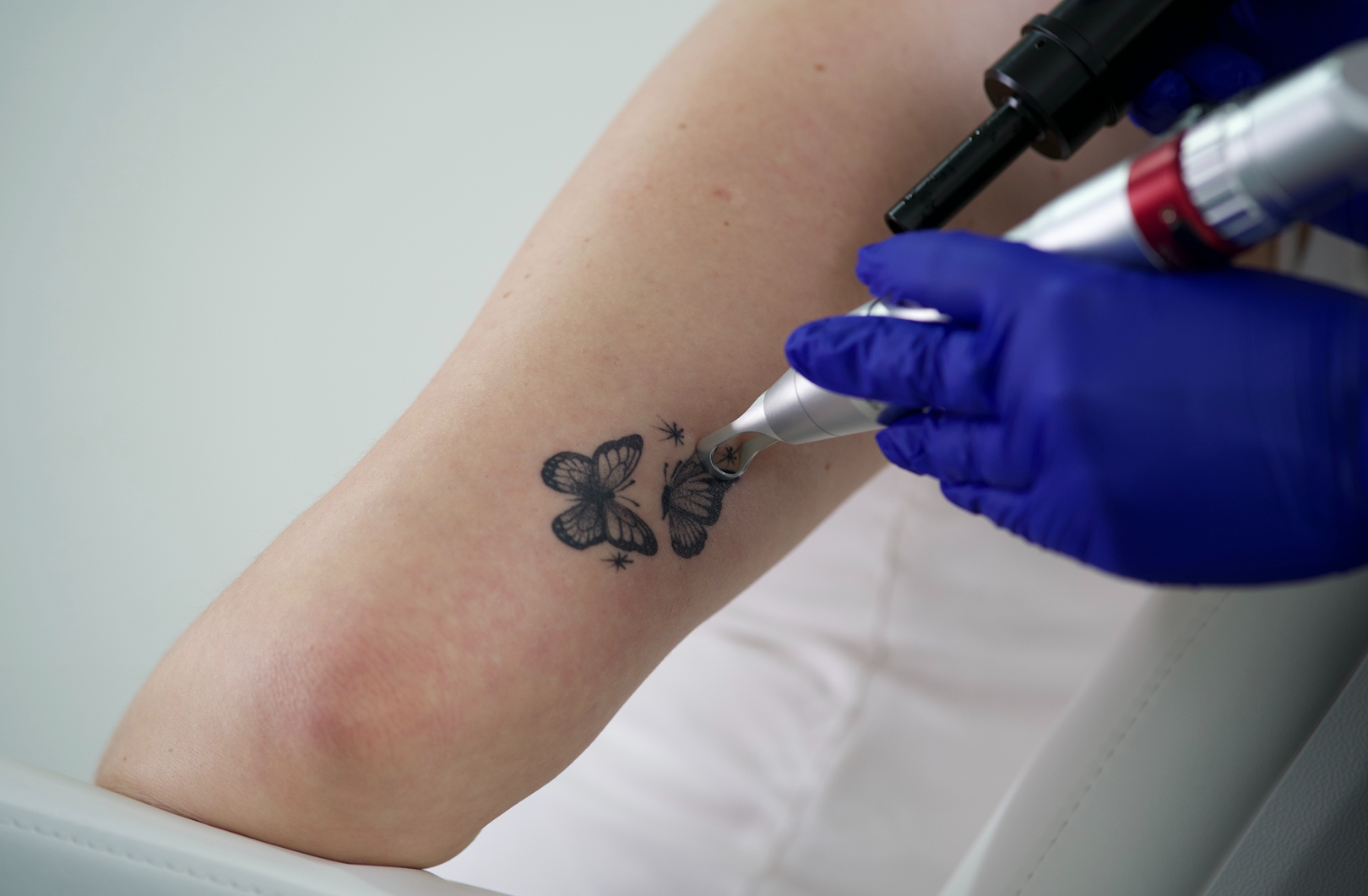 Tattoo Removal